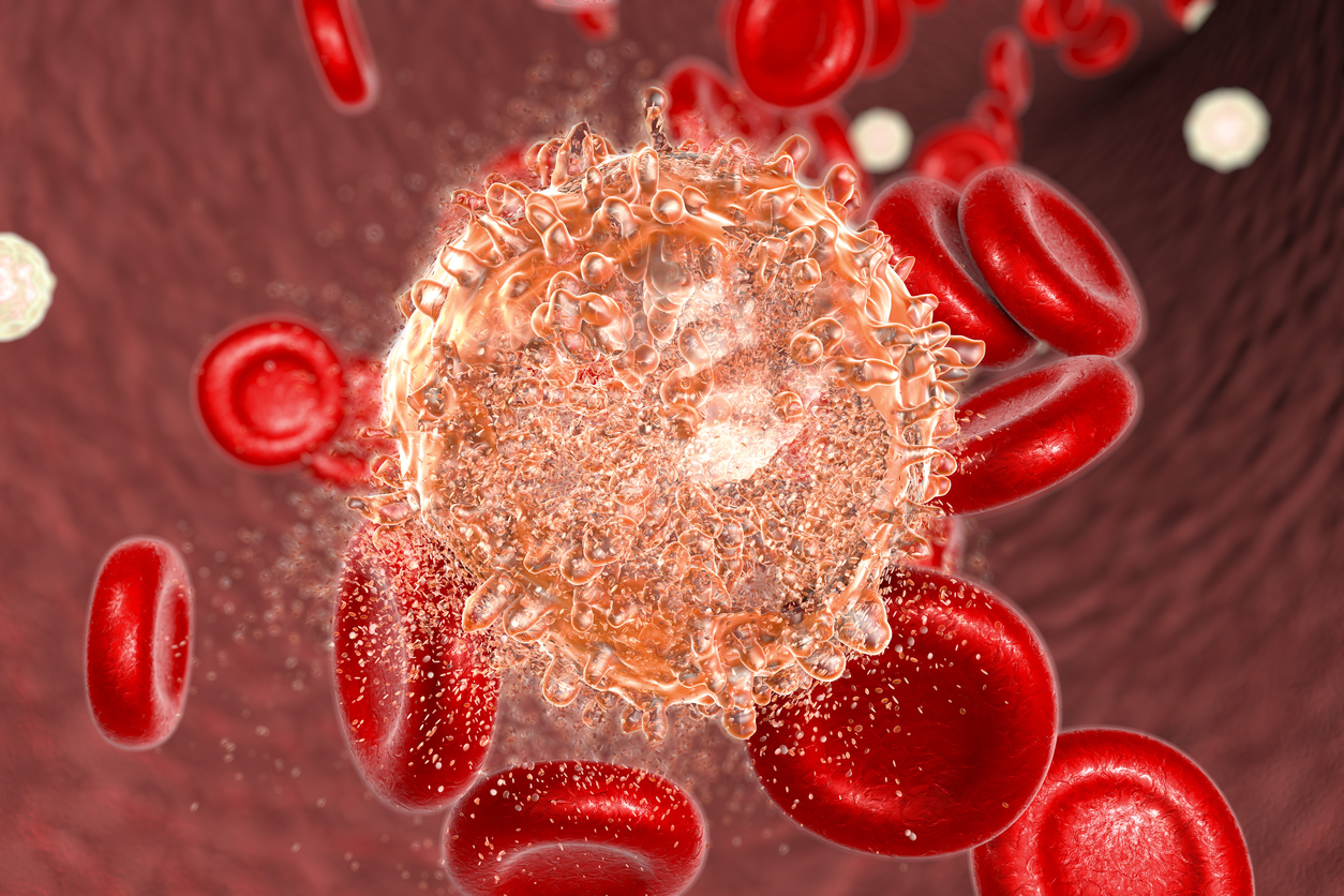 Blutkrebs: Leukämiezellen