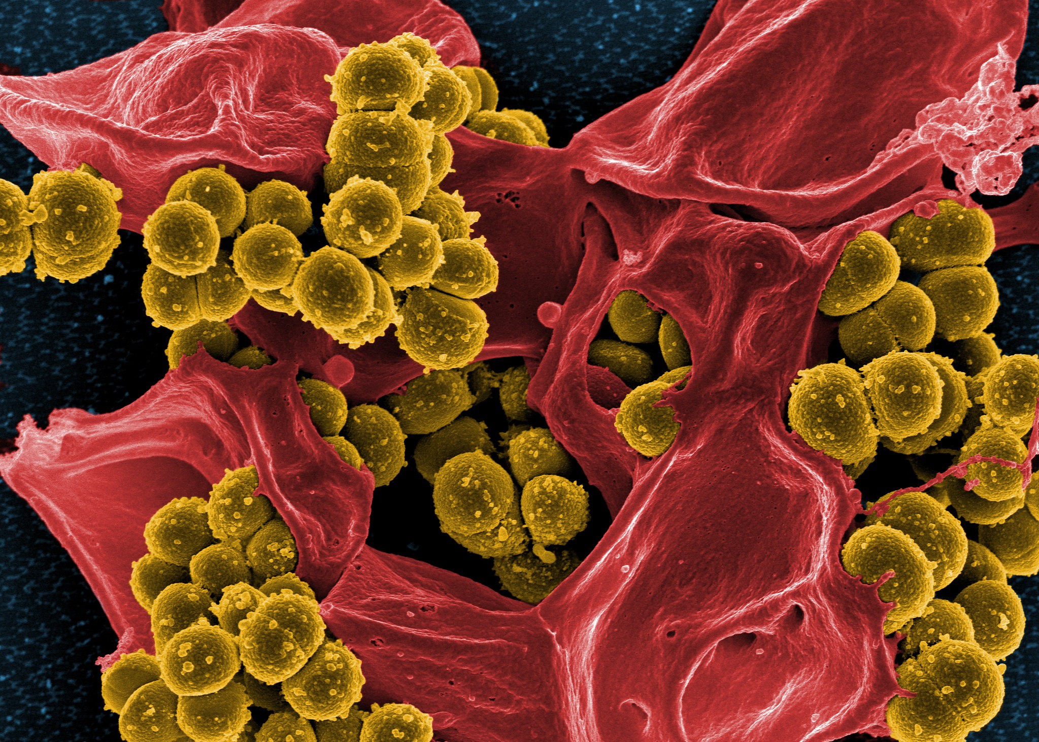 Rasterelektronenmikroskopische Aufnahme des Methicillin-resistenten Bakteriums Staphylococcus aureus (gelb) und eines toten menschlichen weißen Blutkörperchens (rot gefärbt)